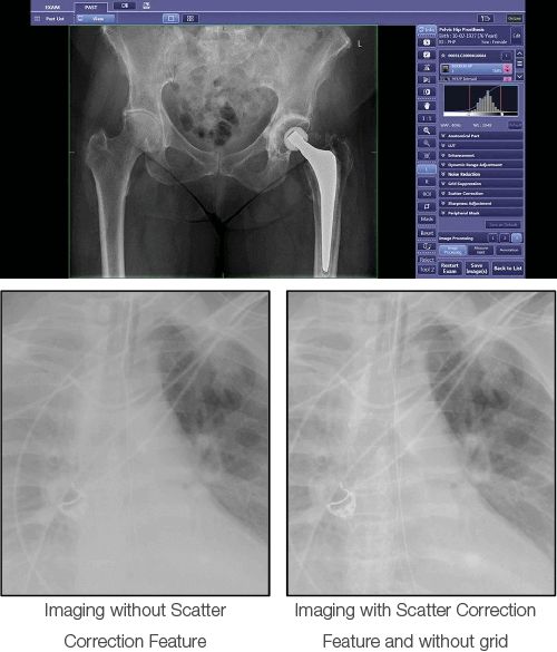 Xray image on the CXDI Control Software NE. Scatter Correction image processing can reduces the effect of scattered radiation for certain types of non-grid bedside examinations.
