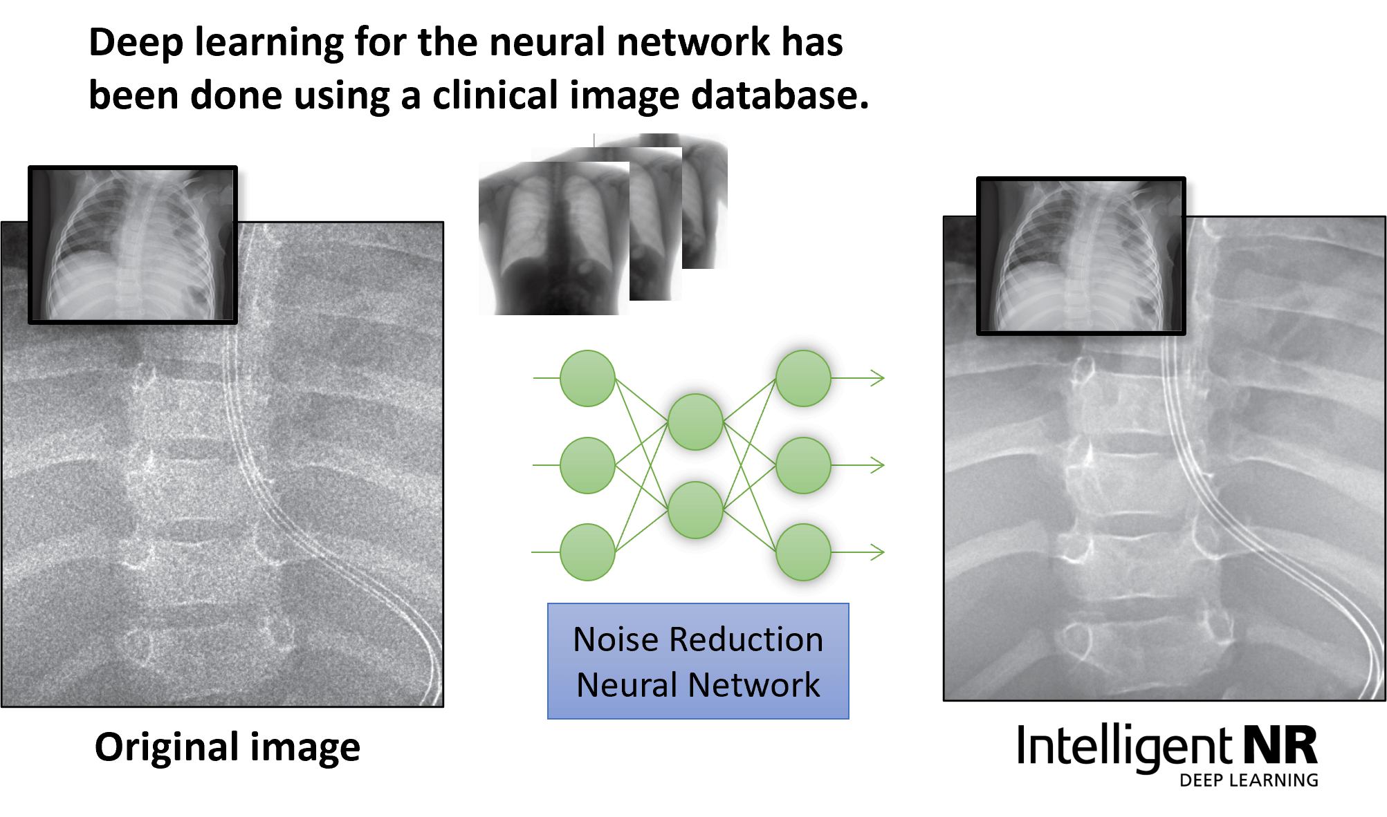 Intelligent NR can reduces noise using deep lerning technology which has trained by clinical image database.