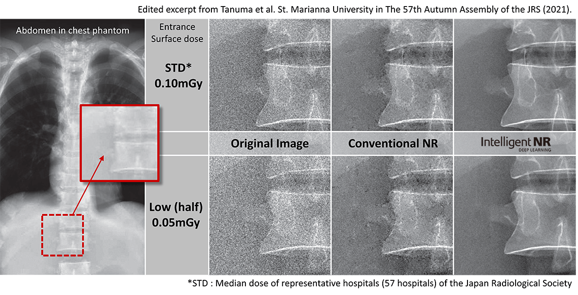 Phantom study from Japanese University shows half dose Intelligent NR image has lett graininess than standard dose conventional NR image.